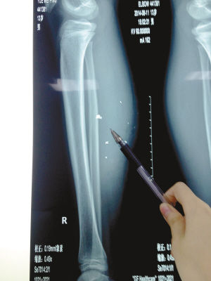 X光片顯示：手機電池內的物質被炸進了小平的右小腿里