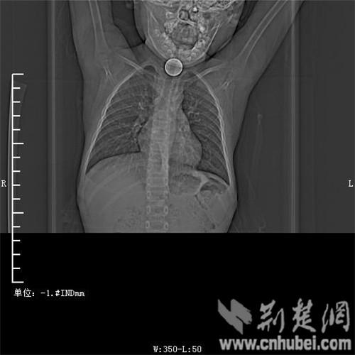 6歲男童玩耍被1元硬幣卡住喉 窒息險喪命(圖)